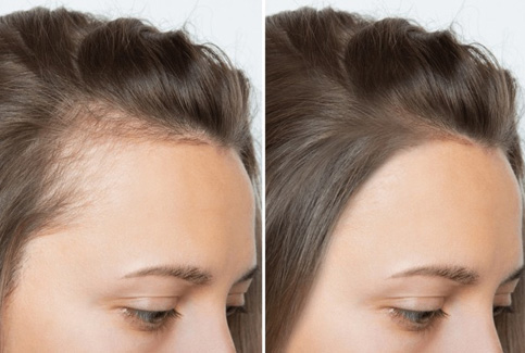 毛发及相关组织产品—防脱发（Anti-Hair Loss）功效测试