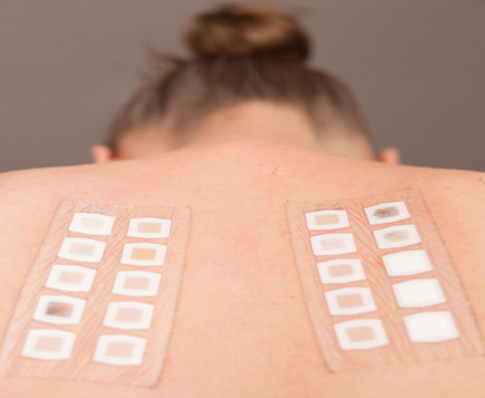 斑贴试验Patch test